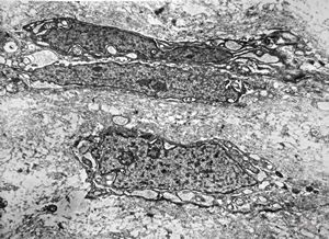 F,12y. | malignant tumor of the orbita - liposarcoma?, neurofibrosarcoma? F,12y. | malignant tumor of the orbita - liposarcoma?, neurofibrosarcoma?